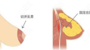 乳房悬吊术,乳房悬吊术的原理与效果解析